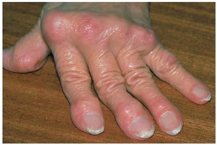 A close-up of a hand deformed by rheumatoid arthritis; the knuckles are swollen and reddened and the fingers curve away from the thumb. (Reproduced by permission of Photo Researchers, Inc.)