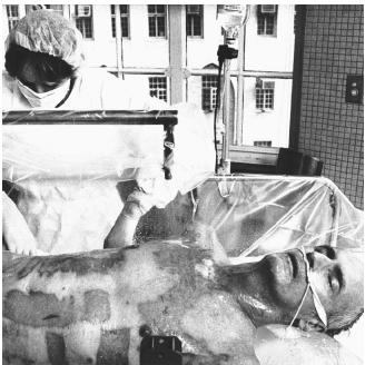A burn sufferer undergoes debridement (the removal of dead skin). The patterns on his chest are from skin grafts. (Reproduced by permission of Phototake.)