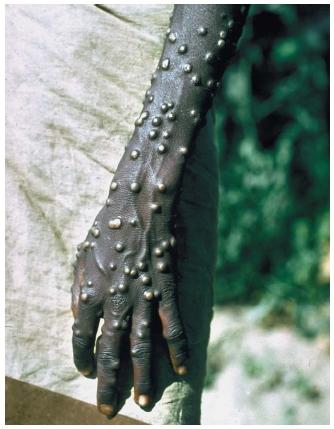Smallpox on the arm of a man in India. (Reproduced by permission of Phototake.)