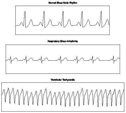 Electrocardiogram rhythm charts. (Reproduced by permission of The Gale Group.)